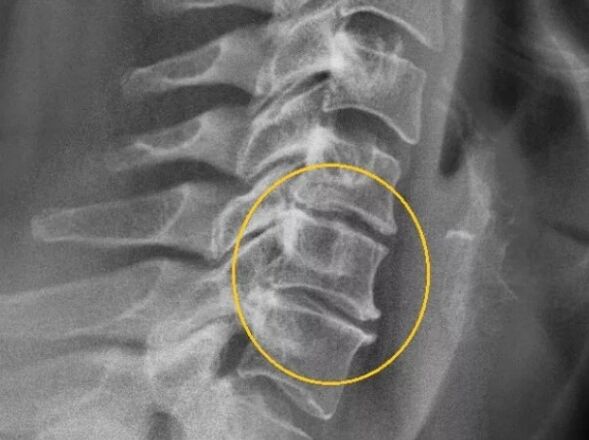 Osteochondrosis krční páteře na x -radě