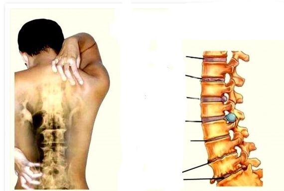 Osteochondrosis je příčinou bolesti zad