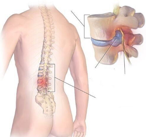 Radikulit je zánětlivý proces v Lumbosacral Department