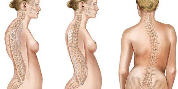 Scoliosis-Mixing Interfertebral Discs